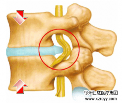 【脊柱】腰突不看年齡，生活習(xí)慣是關(guān)鍵！