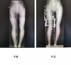 花季少女跛行15年，仁慈骨科利用Ilizarov技術(shù)幫其健康行走