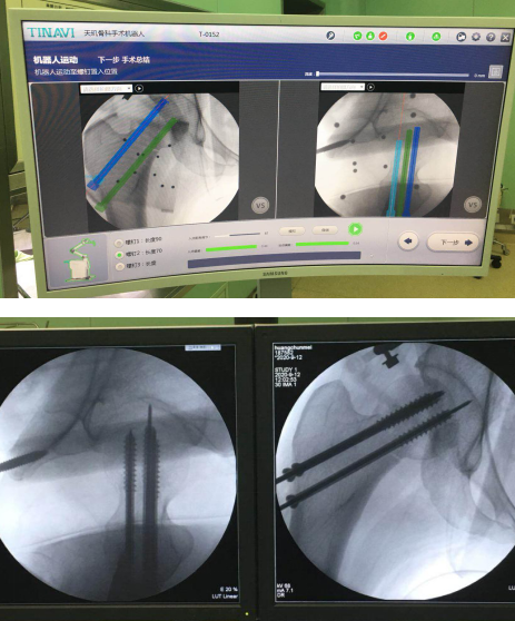 仁慈骨科機(jī)器人